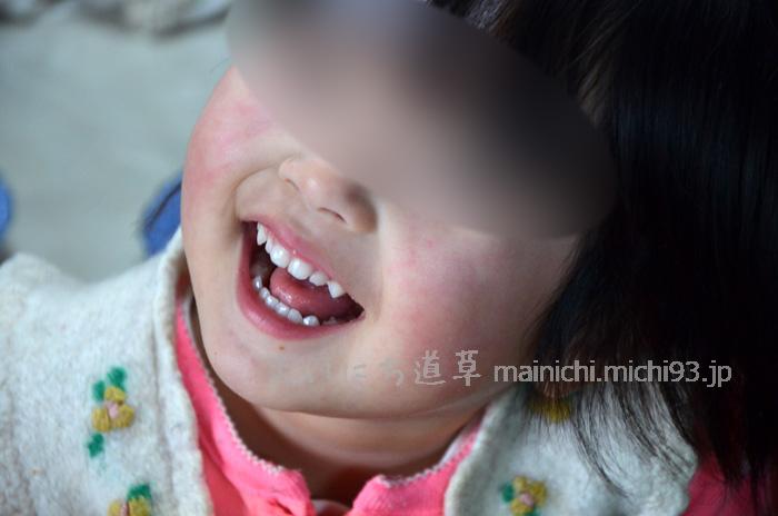 次女もリンゴ病に