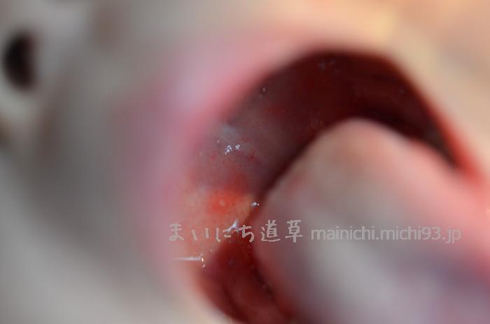 先端が白い発疹