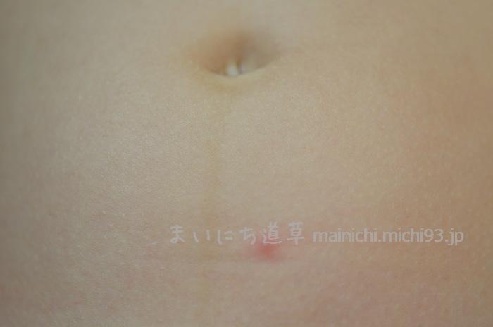 お腹の発疹