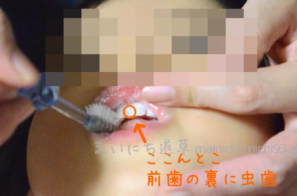 前歯の裏に虫歯ができた