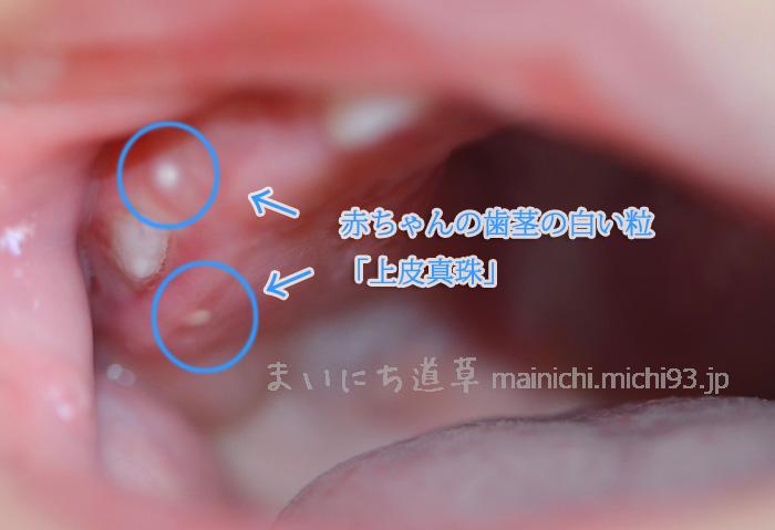 白い 点 歯茎 赤ちゃん 赤ちゃんの歯茎に血豆や白い点があるのは大丈夫？黒い場合は病気なの？